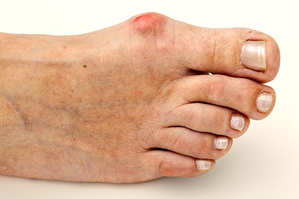 foot-problems-bunions